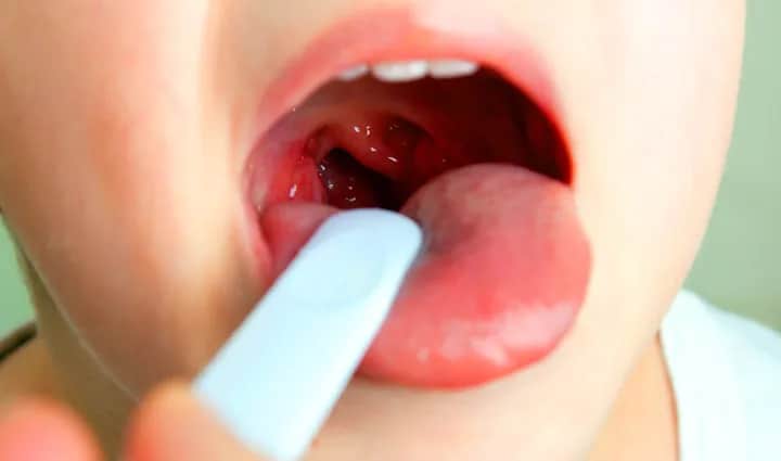 Jak rozpoznać objawy bólu gardła u niemowlaka i kiedy działać