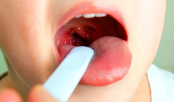 Jak rozpoznać objawy bólu gardła u niemowlaka i kiedy działać