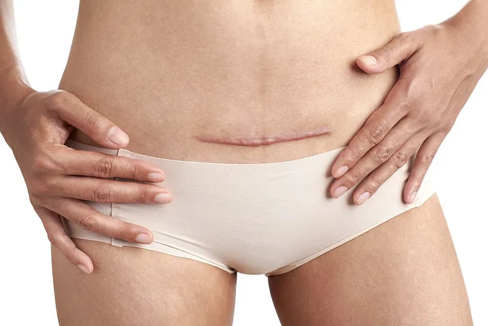 Jak długo trwa ból po cesarce? Co musisz wiedzieć o bólu po porodzie