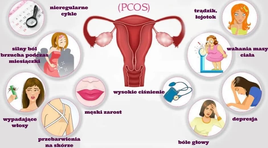 PCO syndrom co to jest - objawy, diagnoza i skutki zdrowotne