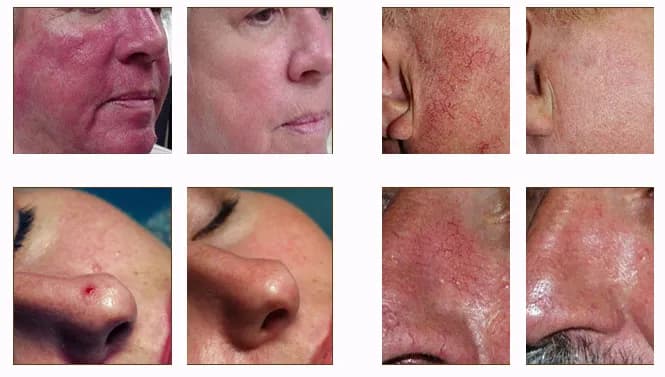 Skutki uboczne laserowego zamykania naczynek - co warto wiedzieć?